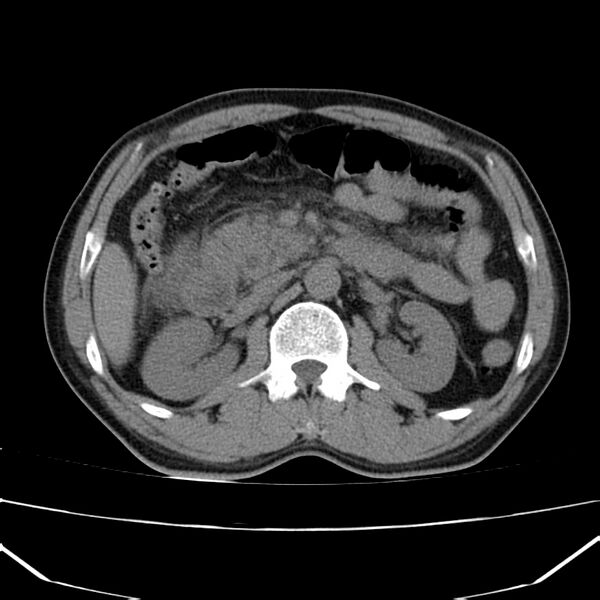 File:Acute pancreatitis (Radiopaedia 22572-22596 Axial non-contrast 25).jpg