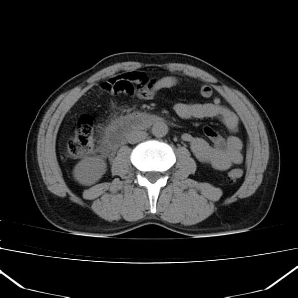 File:Acute pancreatitis (Radiopaedia 22572-22596 Axial non-contrast 33).jpg