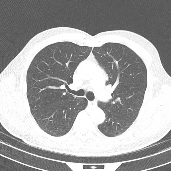 File:Acute pulmonary embolism (Radiopaedia 81677-95570 Axial lung window 18).jpg