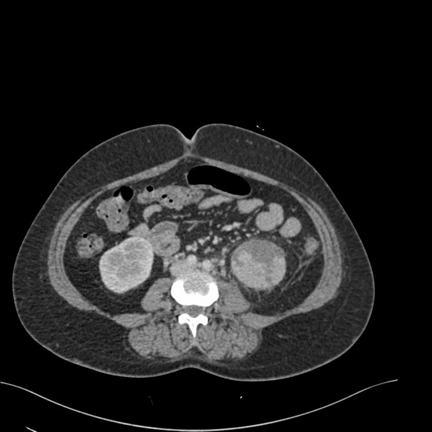 Acute pyelonephritis with renal vein thrombosis (Radiopaedia 58020-65053 Axial renal parenchymal phase 114).jpg