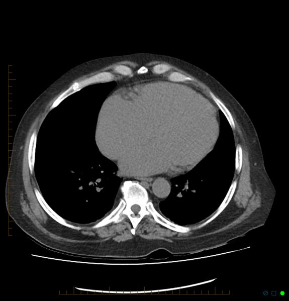 File:Acute renal failure post IV contrast injection- CT findings (Radiopaedia 47815-52557 Axial non-contrast 2).jpg
