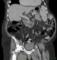 Acute renal failure post IV contrast injection- CT findings (Radiopaedia 47815-52559 Coronal C+ portal venous phase 10).jpg
