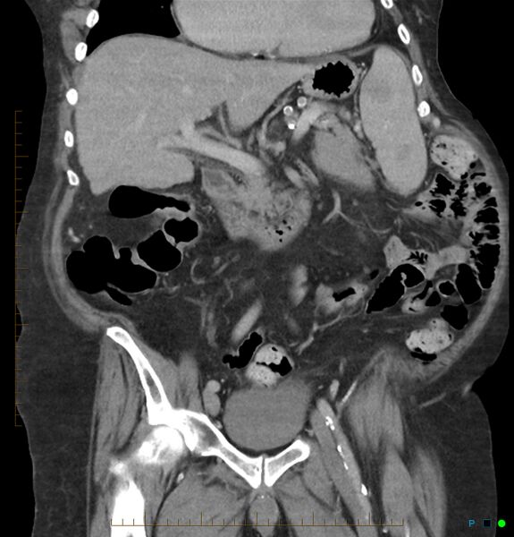 File:Acute renal failure post IV contrast injection- CT findings (Radiopaedia 47815-52559 Coronal C+ portal venous phase 10).jpg