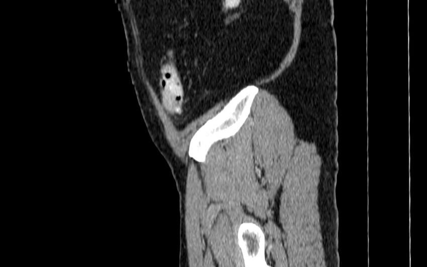 Acute sigmoid colon diverticulitis (Radiopaedia 55507-61976 Sagittal C+ portal venous phase 128).jpg