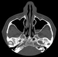 Acute sinusitis (Radiopaedia 23161-23215 Axial bone window 27).jpg