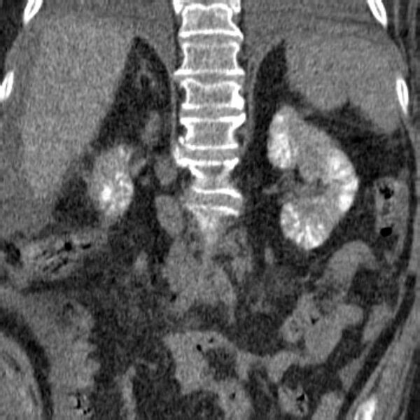 File:Acute tubular necrosis (Radiopaedia 28077-28334 Coronal non-contrast 10).jpg