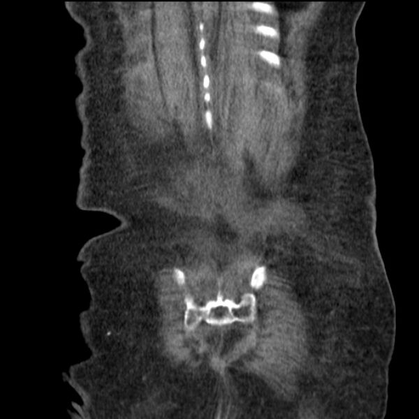 File:Acute tubular necrosis (Radiopaedia 28077-28334 D 75).jpg