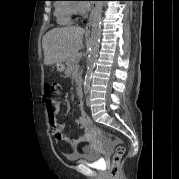File:Acute tubular necrosis (Radiopaedia 28077-28334 Sagittal non-contrast 47).jpg