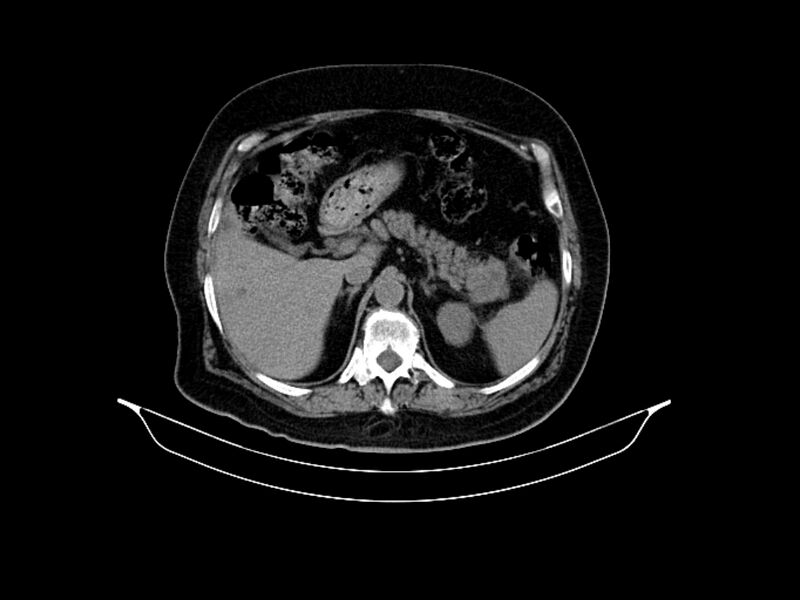 File:Adenocarcinoma of pancreas with hepatic metastasis (Radiopaedia 64332-73122 Axial non-contrast 32).jpg