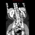 Adenocarcinoma of the colon (Radiopaedia 8191-9039 Coronal liver window 35).jpg
