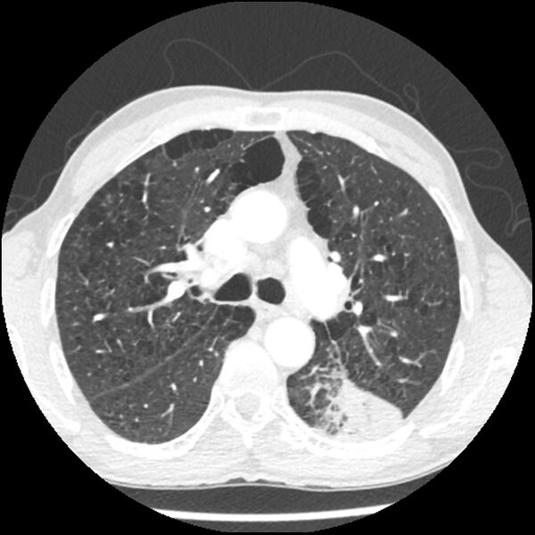 File:Adenocarcinoma of the lung - micropapillary predominant (Radiopaedia 42446-45563 C 19).jpg