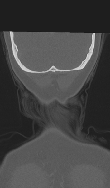 File:Adenoid cystic tumor of palate (Radiopaedia 46980-51518 Coronal bone window 58).png