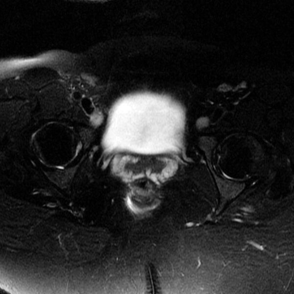 File:Adenomyosis of the uterus (Radiopaedia 9869-10437 Axial T2 6).jpg