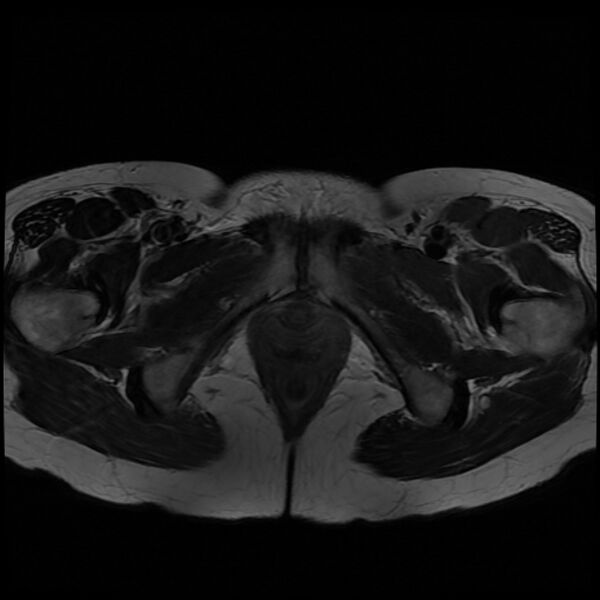 File:Adenomyosis on MRI (Radiopaedia 29328-29780 Axial T2 13).jpg