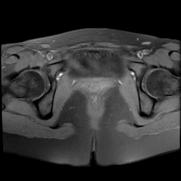 File:Adenomyosis within a septate uterus (Radiopaedia 69963-79981 Axial T1 fat sat 23).jpg