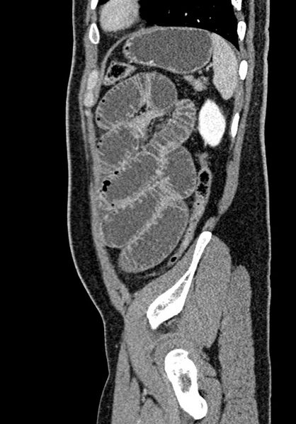 File:Adhesional small bowel obstruction (Radiopaedia 58900-66131 Sagittal C+ portal venous phase 205).jpg