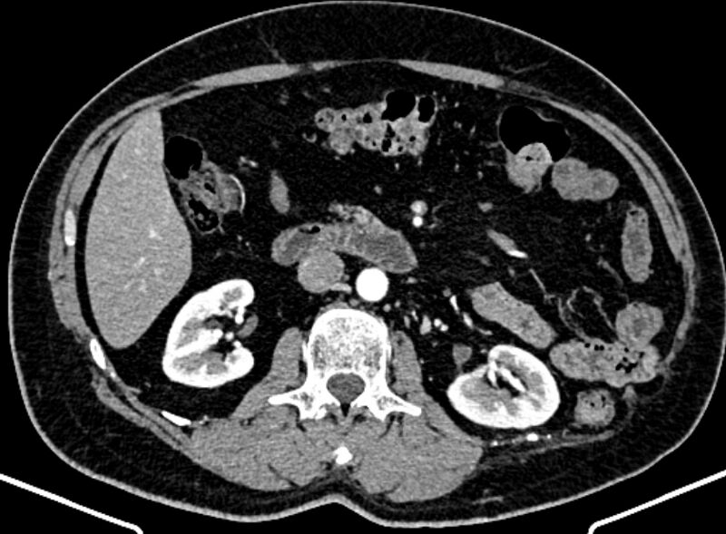 File:Adrenal metastases (Radiopaedia 73082-83791 Axial C+ arterial phase 79).jpg
