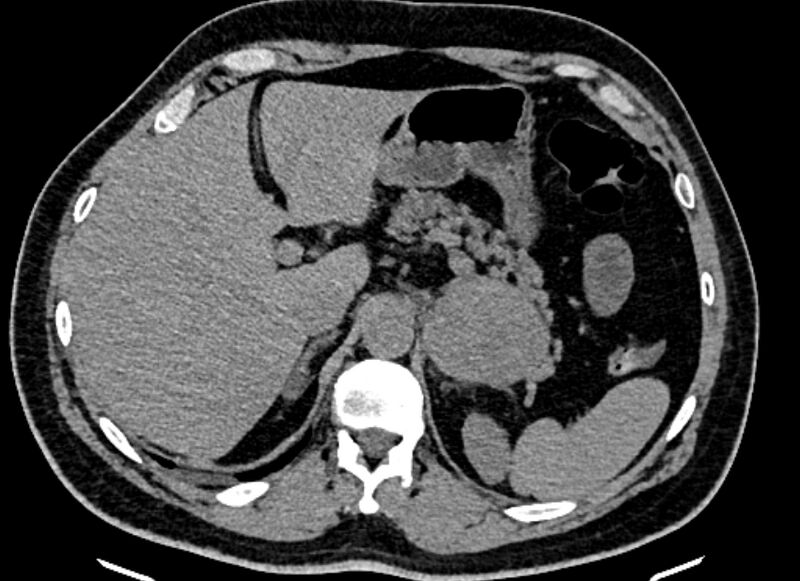 File:Adrenal metastases (Radiopaedia 73082-83791 Axial non-contrast 44).jpg