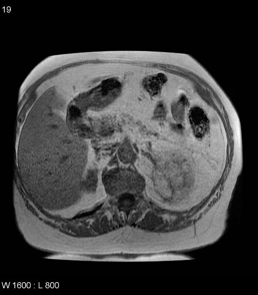 File:Adrenal myelolipoma (Radiopaedia 6765-7961 Axial T1 in-phase 19).jpg