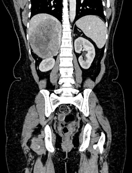 File:Adrenocortical carcinoma (Radiopaedia 87281-103569 Coronal C+ portal venous phase 88).jpg