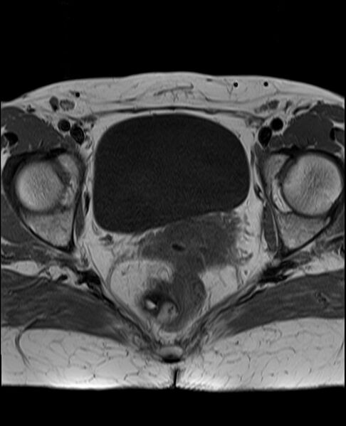 File:Adult granulosa cell tumor of the ovary (Radiopaedia 71581-81950 Axial T1 19).jpg