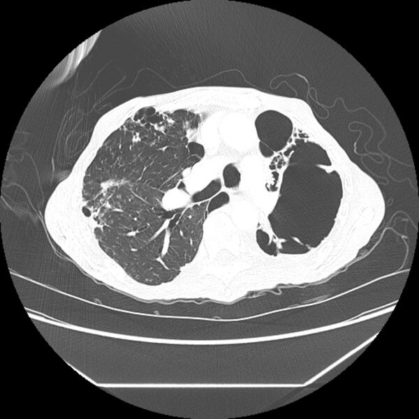 File:Advanced pulmonary tuberculosis (Radiopaedia 8599-9431 Axial lung window 20).jpg