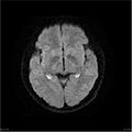 Amnestic syndrome secondary to hypoxic brain injury (Radiopaedia 24743-25004 DWI 15).jpg