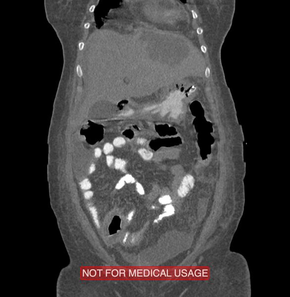 File:Amoebic enterocolitis with liver abscess (Radiopaedia 35100-36609 B 37).jpg