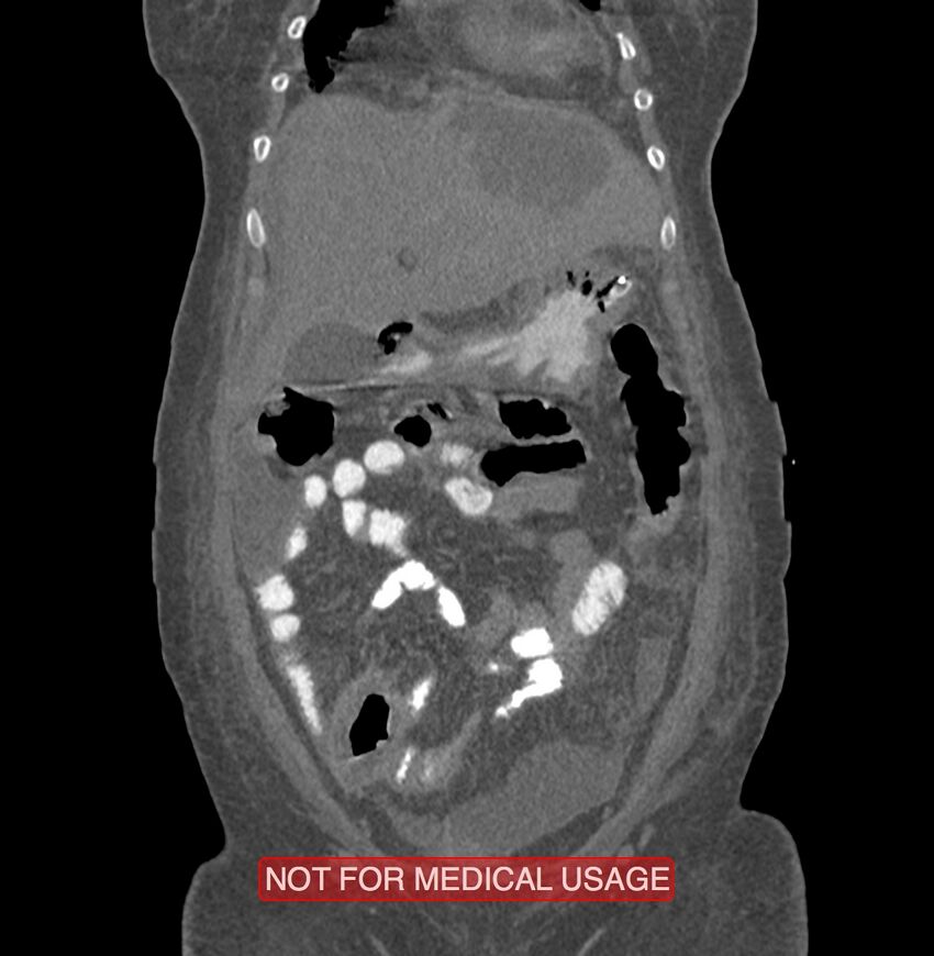 Amoebic enterocolitis with liver abscess (Radiopaedia 35100-36609 B 37).jpg