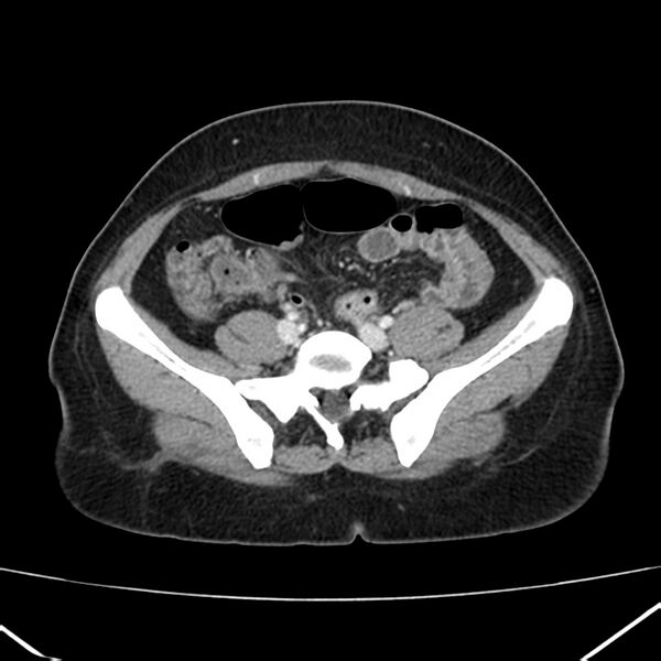 File:Ampullary tumor (Radiopaedia 22787-22816 C 49).jpg