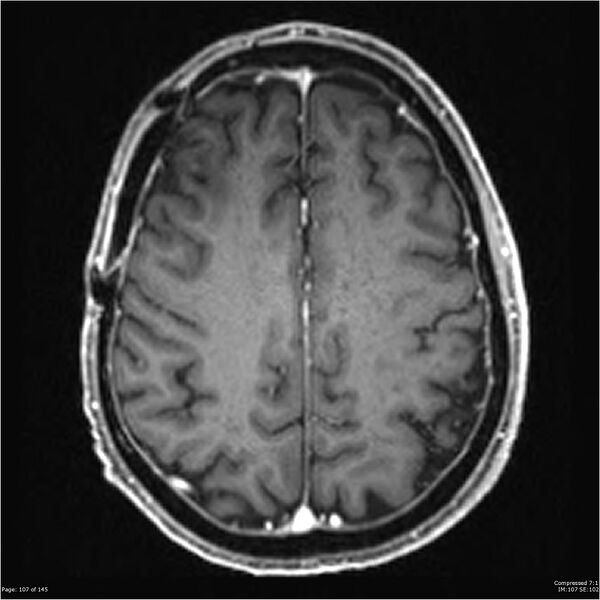 File:Anaplastic meningioma with recurrence (Radiopaedia 34452-35788 Axial T1 C+ 107).jpg