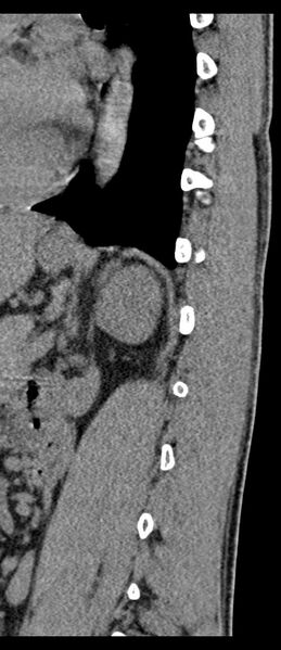 File:Aneurysmal bone cyst T11 (Radiopaedia 29294-29721 E 19).jpg