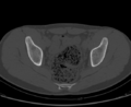 Aneurysmal bone cyst of ischium (Radiopaedia 25957-26094 Axial bone window 45).png