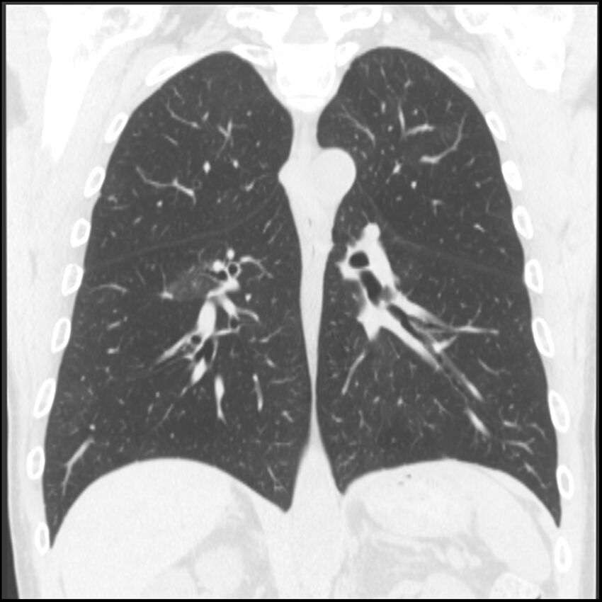 Angioinvasive aspergillosis (Radiopaedia 43957-47466 Coronal lung window 38).jpg