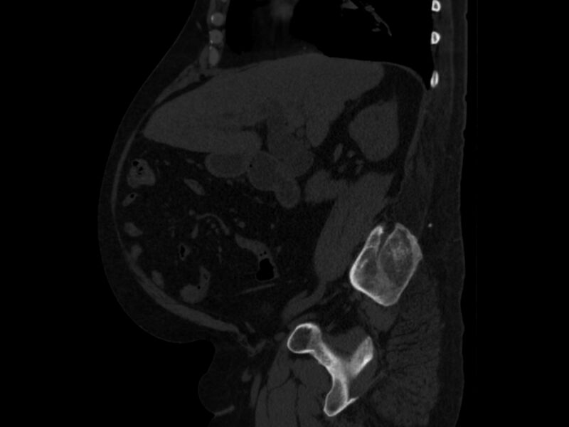 File:Ankylosing spondylitis (Radiopaedia 44609-48357 Sagittal bone window 35).jpg
