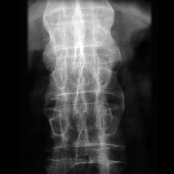 File:Ankylosing spondylitis - lumbar spine (Radiopaedia 7163-8136 Frontal 1).jpg
