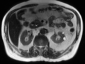 Annular pancreas (Radiopaedia 38292-40320 Axial T2 17).png