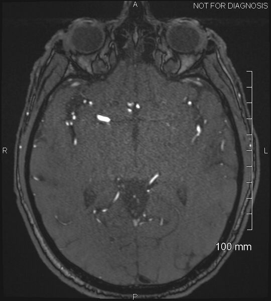 File:Anterior cerebral artery aneurysm (Radiopaedia 80683-94127 Axial MRA 111).jpg