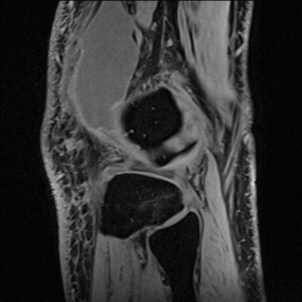 File:Anterior cruciate ligament tear - ramp lesion (Radiopaedia 71883-82322 Sagittal T1 vibe 27).jpg