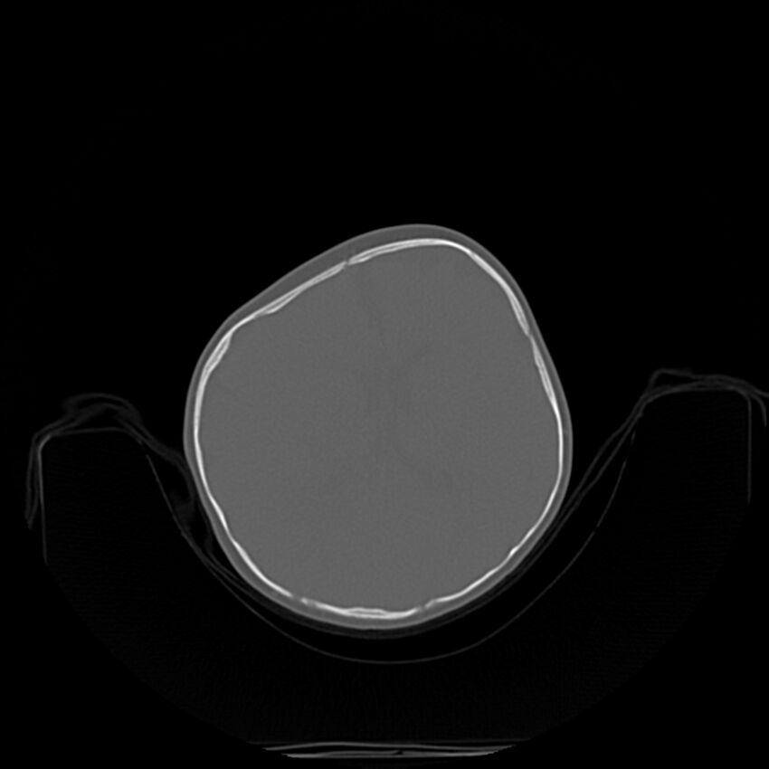 Anterior plagiocephaly (Radiopaedia 71836-82273 C 47).jpg