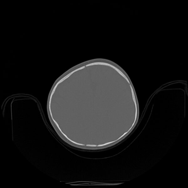 File:Anterior plagiocephaly (Radiopaedia 71836-82273 C 67).jpg