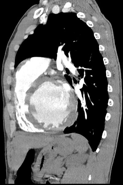 File:Aortic coarctation with aneurysm (Radiopaedia 74818-85828 B 105).jpg