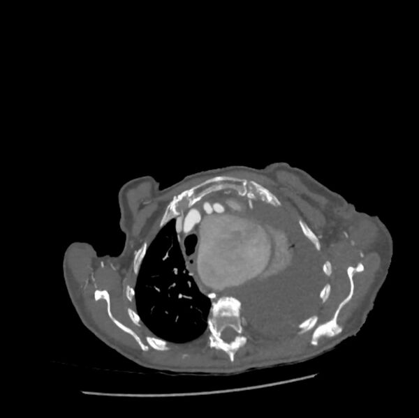 File:Aortic dissection (Radiopaedia 68763-78691 A 7).jpeg