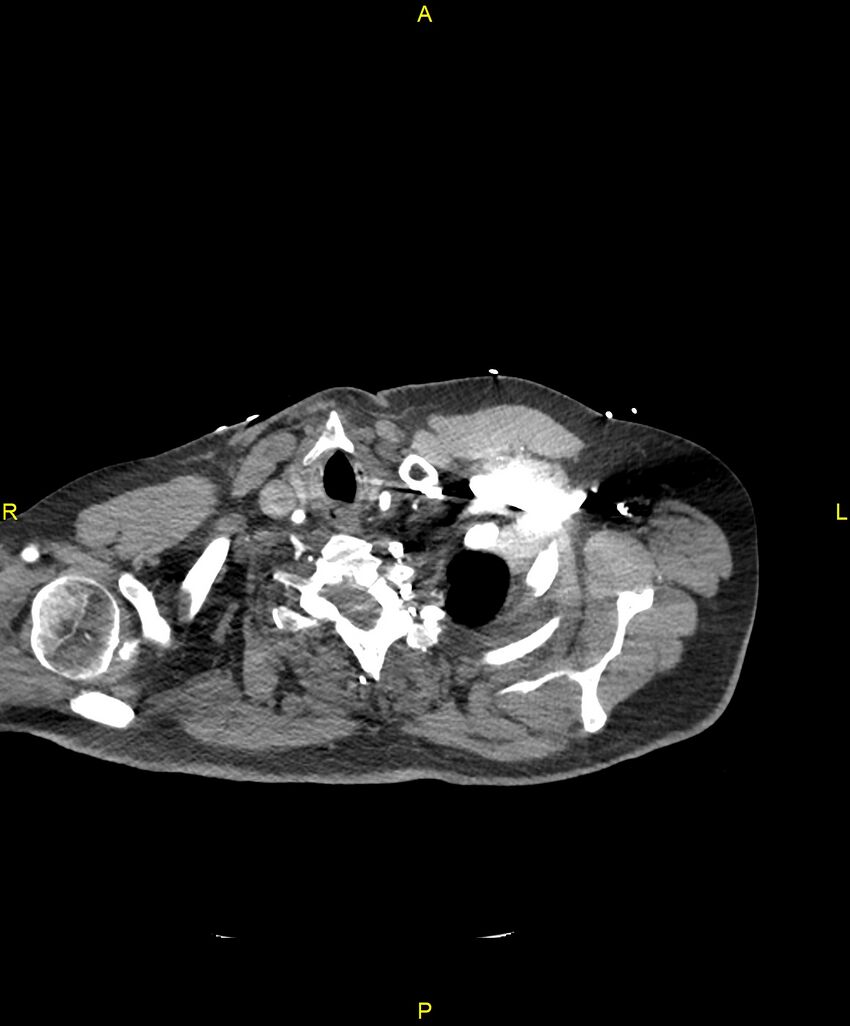 Aortic rupture (Radiopaedia 88822-105594 B 10).jpg