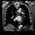Aorto-coronary bypass graft aneurysms (Radiopaedia 40562-43157 B 29).png