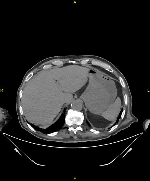 File:Aortoenteric fistula (Radiopaedia 84308-99603 Axial non-contrast 45).jpg