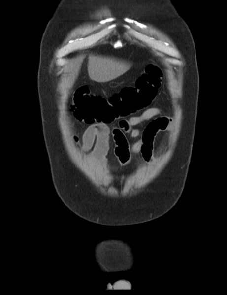 File:Appendicitis and giant appendicolith (Radiopaedia 80251-93588 Coronal non-contrast 5).jpg