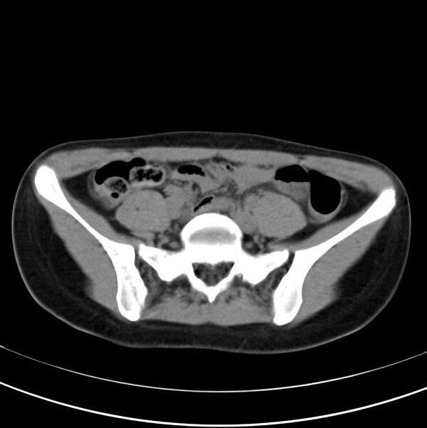 File:Appendicitis and incidental bicornuate uterus (Radiopaedia 22833-22853 Axial non-contrast 32).jpg