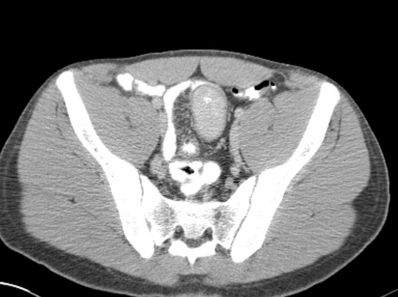 File:Appendicitis and incidental foregut duplication cyst (Radiopaedia 52962-58916 A 77).jpg