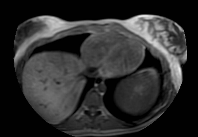 File:Appendicitis in gravida (MRI) (Radiopaedia 89433-106395 Axial T1 in-phase 1).jpg
